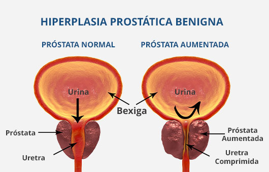 Imagem-interna-Enucleação-da-prostata-Joao-Caprini